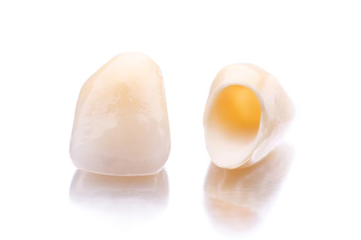 porcelain crowns in Wooland Hills