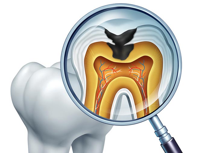 root canal therapy in Woodland Hills