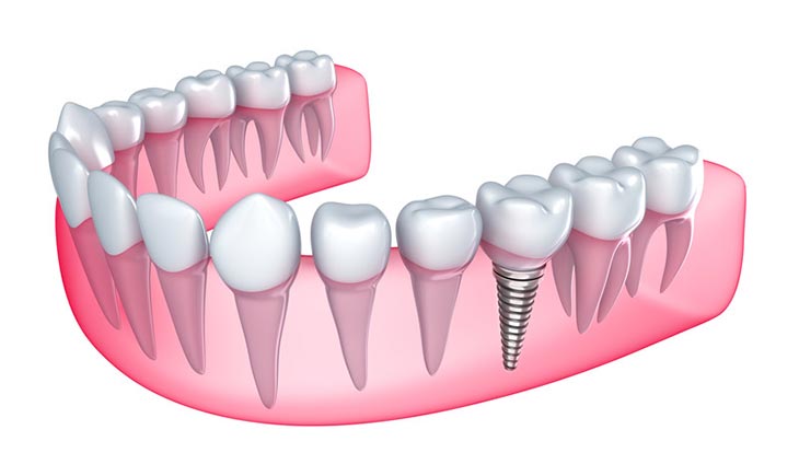 implant dentistry in woodland hills