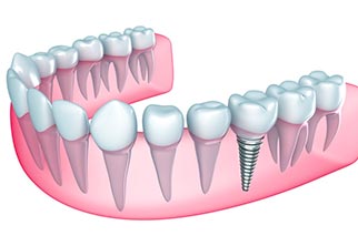 Implant Dentistry