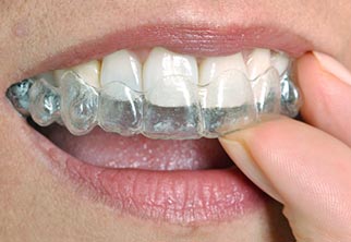 Invisalign