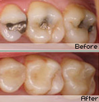 Composite Fillings in Woodland Hills