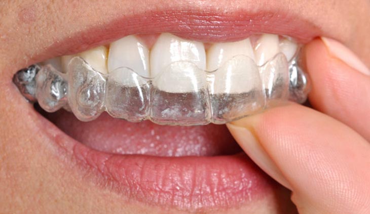 Invisalign Woodland Hills