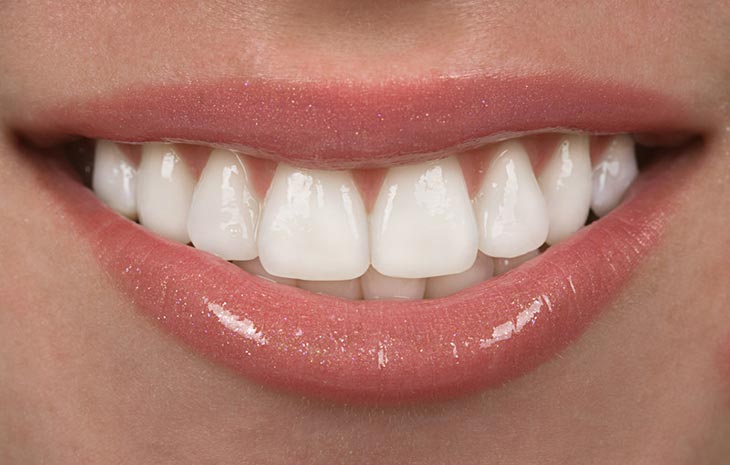 Ceramic Veneers in Woodland Hills